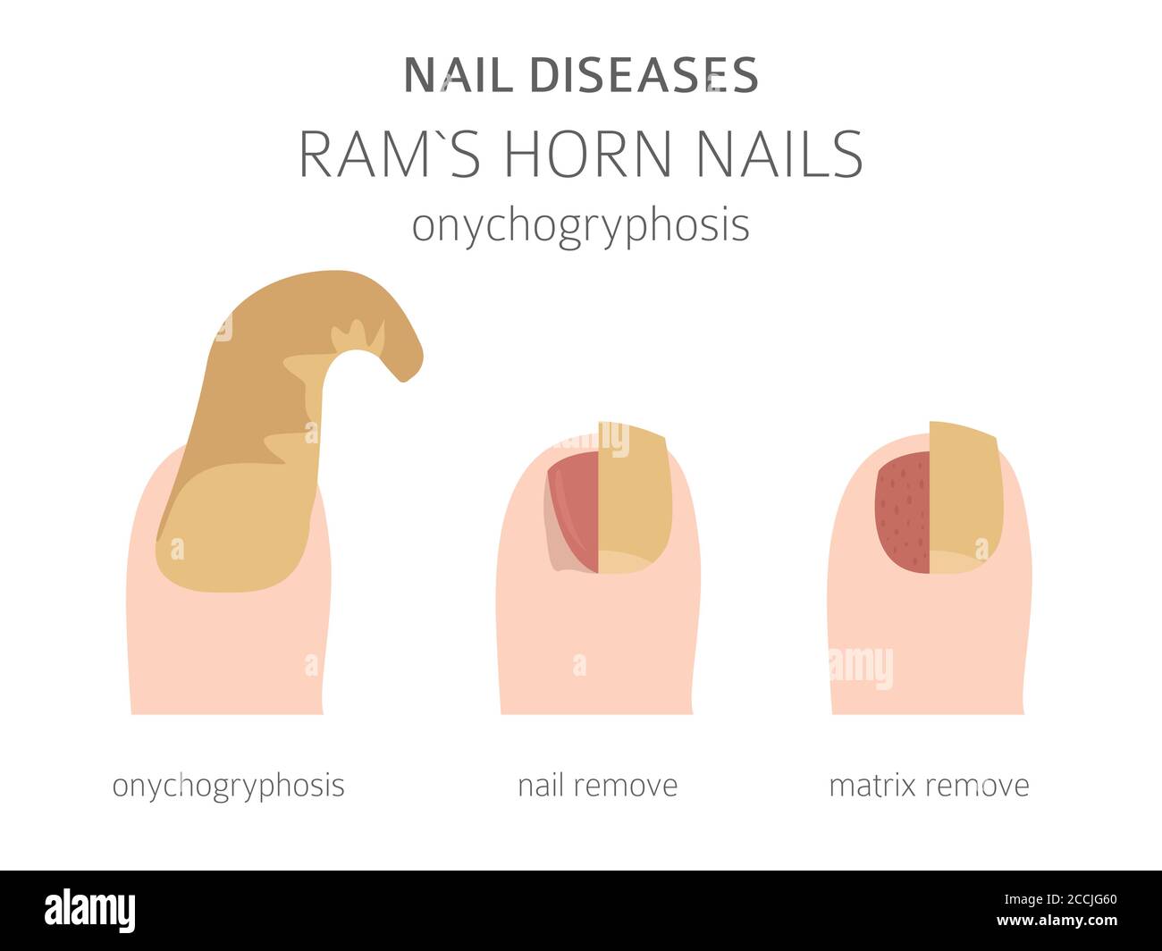 Nail diseases. Onychogryphosis, Ram`s horn nail. Medical infographic